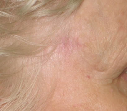 Fully healed close up forehead after Mohs surgery