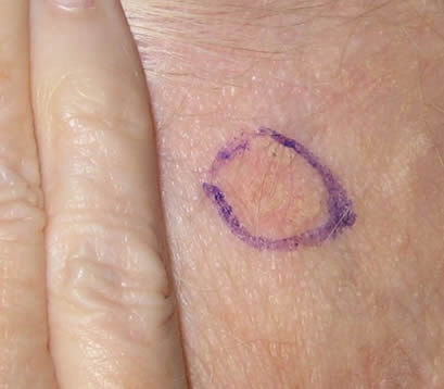 Closeup of skin cancer on forehead of older female before Mohs surgery