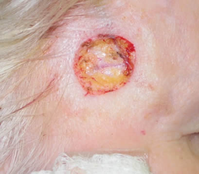 Closeup of open wound on forehead of older female after Mohs surgery
