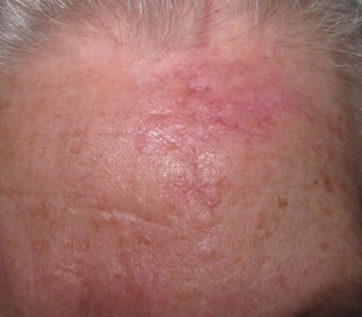 2 month after MOHS surgery for skin cancer on forehead