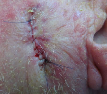 Skin cancer left cheek after MOHS surgery closure
