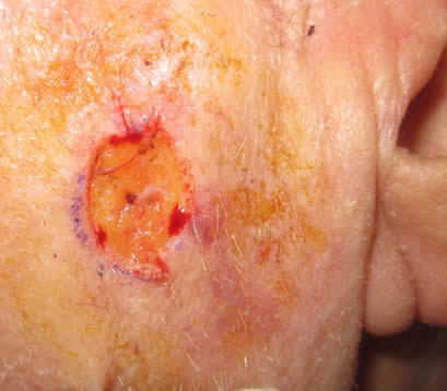 Skin cancer left cheek after MOHS surgery open wound