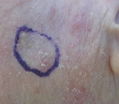 Skin cancer left cheek before MOHS surgery