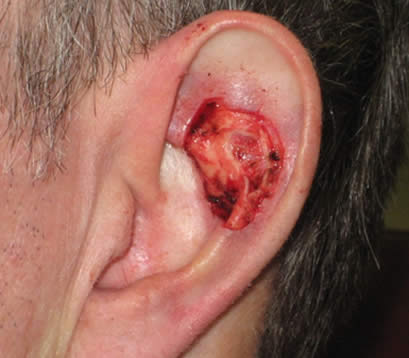 Skin cancer on left ear post MOHS surgery open wound