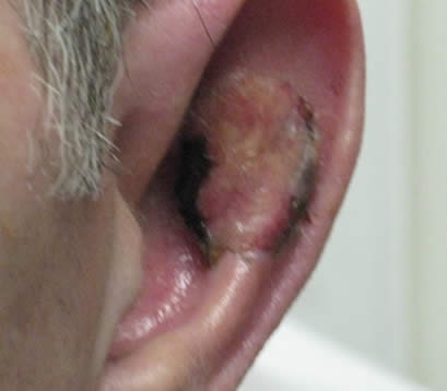 Skin cancer on left ear post MOHS surgery skin graft