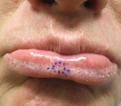 Skin cancer on lower lip before MOHS surgery