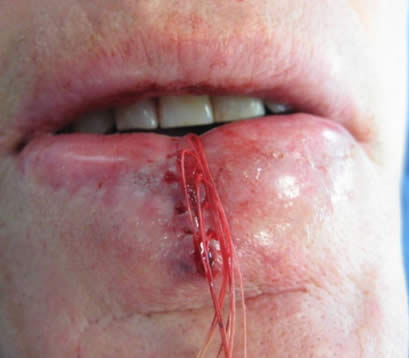 Skin cancer on lower lip post MOHS surgery closure