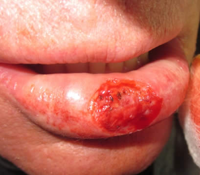 Skin cancer on lower lip post MOHS surgery open wound