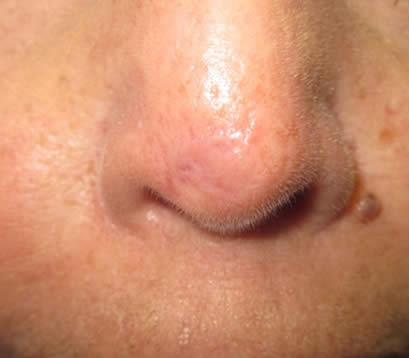 Skin cancer on tip of nose after MOHS surgery 3 months