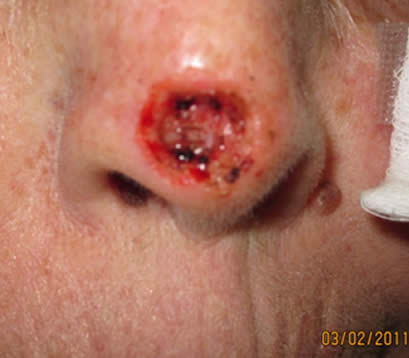 Skin cancer on tip of nose after MOHS surgery open wound
