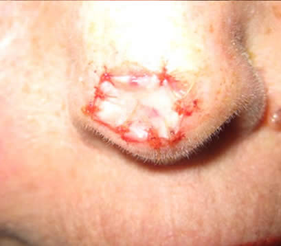 Skin cancer on tip of nose after MOHS surgery skin graft