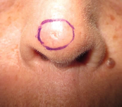 Skin cancer on tip of nose before MOHS surgery