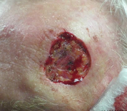 Skin cancer on upper left side forehead after MOHS open wound