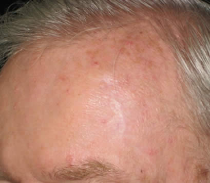 Skin cancer on upper left side forehead after MOHS surgery 6 months