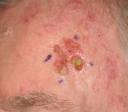 Skin cancer on upper left side forehead before MOHS surgery