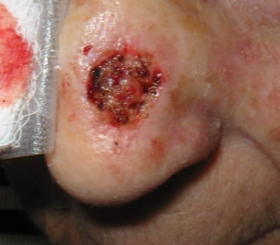 Treating Skin cancer left side of nose after MOHS open wound