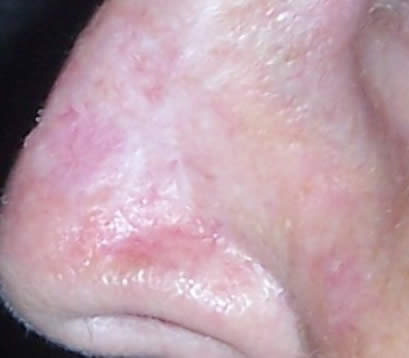 Treating Skin cancer left side of nose after MOHS surgery 6 months
