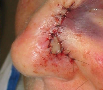 Treating Skin cancer left side of nose after MOHS with closure and skin graft