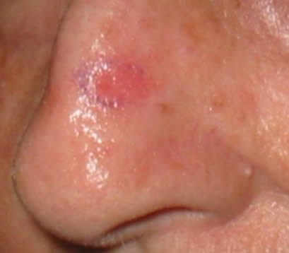 Treating Skin cancer left side of nose before MOHS surgery