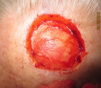 open wound after MOHS surgery for skin cancer on forehead