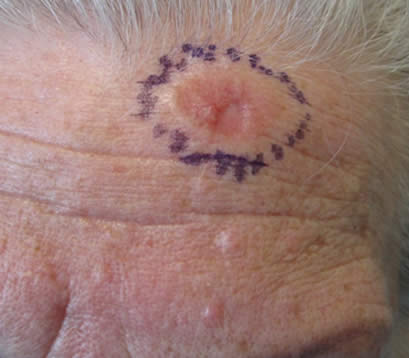 skin cancer before MOHS surgery on forehead