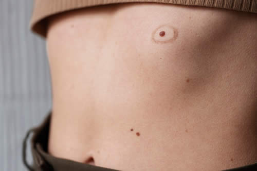 woman-with-melanoma-her-skin