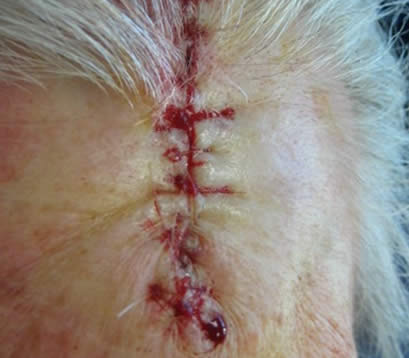 wound closure after MOHS surgery for skin cancer on forehead